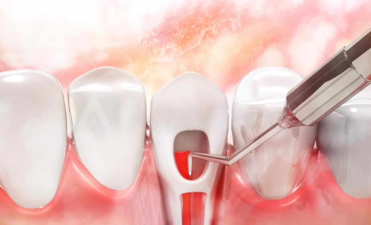 How you can benefit from root canal
