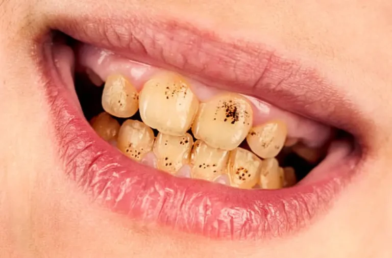 How to remove brown stains from teeth naturally